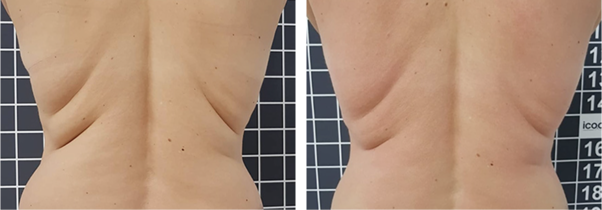 ICOONE body contouring before and after