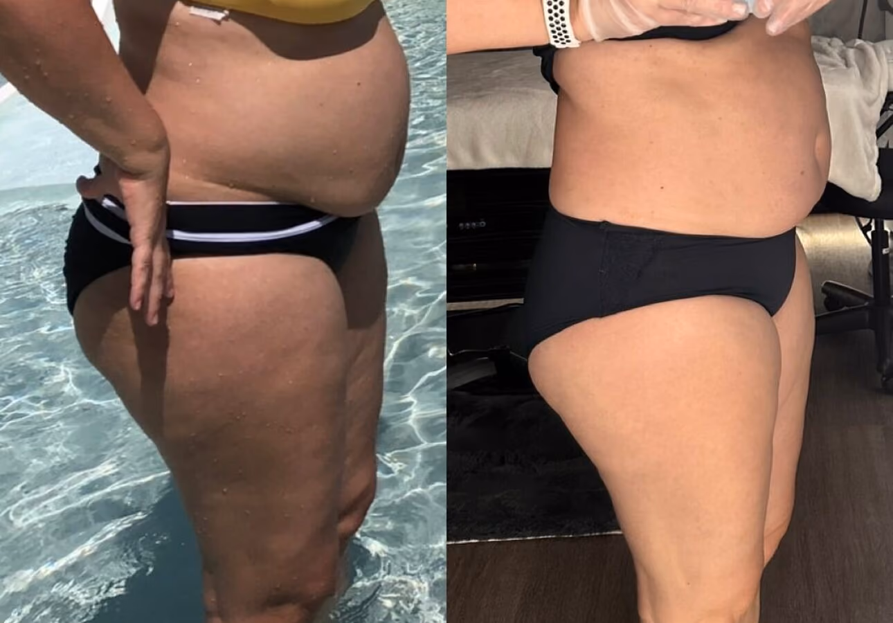 Endospheres body remodeling before and after